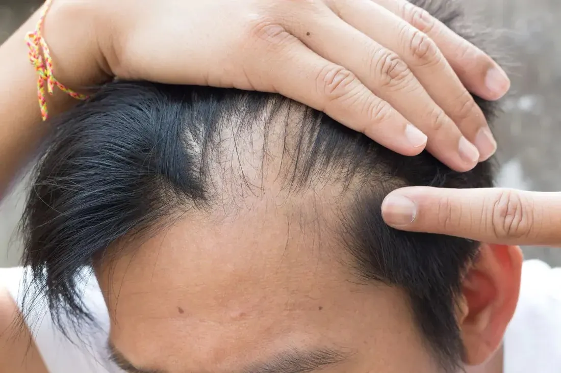 akar rambut mati
