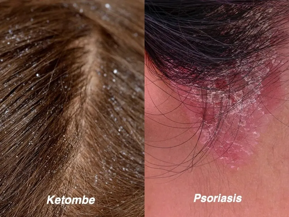 ketombe dan psoriasis
