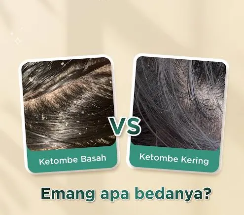 Ketombe Basah vs Ketombe Kering