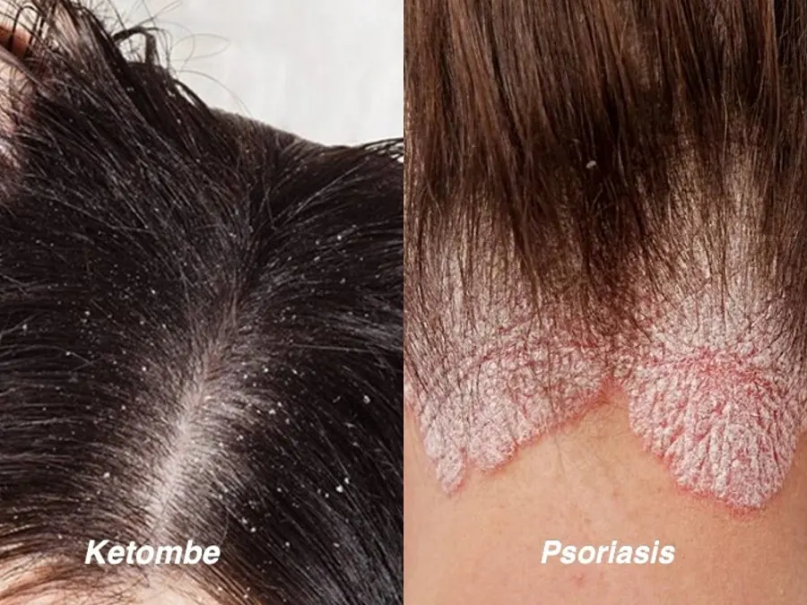 psoriasis