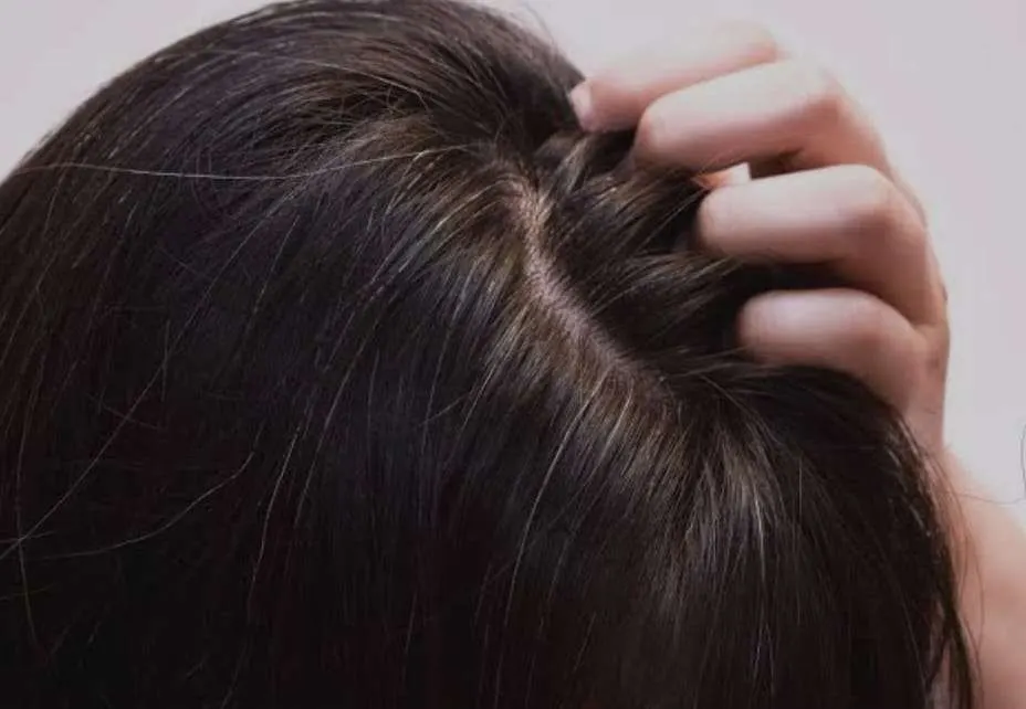 Kurang Vitamin Apa Sih yang Bikin Rambut Cepat Beruban? Yuk, Simak!