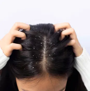 7 Perubahan Hormonal Pemicu Ketombe yang Perlu Kamu Tahu