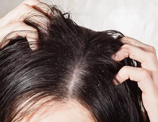 7 Tanda Tingkat Keparahan Ketombe di Rambut yang Perlu Kamu Ketahui