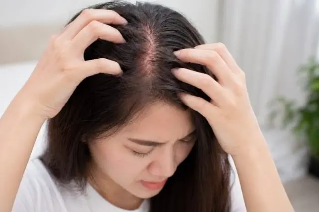 Kulit Kepala Sensitif dan Mudah Gatal? Ini Cara Menutrisinya Secara Mendalam